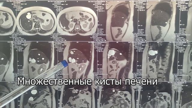 Поликистоз печени Компьютерная томограмма смотреть онлайн