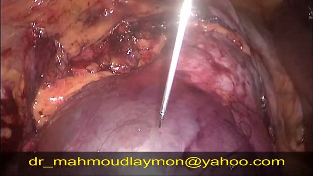 laparoscopic decortication of simple renal cyst смотреть онлайн