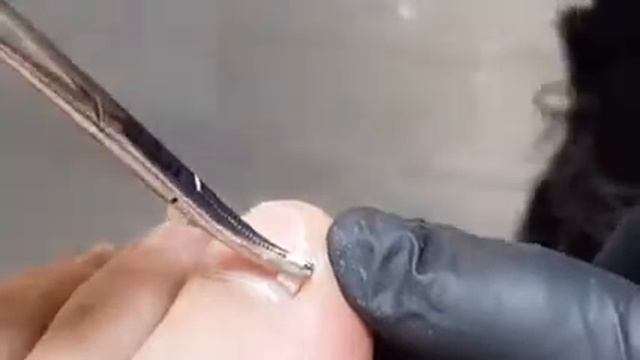 Подологическая практика Ортониксия. Скоба COMBI NiTi титановая нить смотреть онлайн