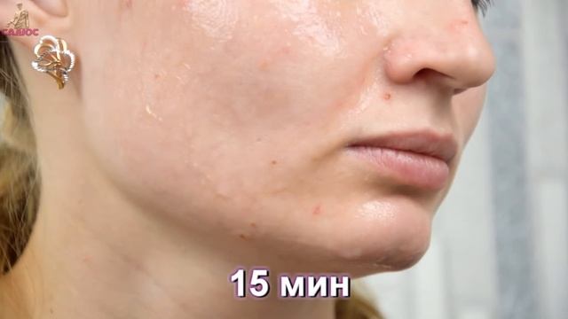 ?Натуральная маска для жирной кожи лица, своими руками. Быстрый эффект смотреть онлайн
