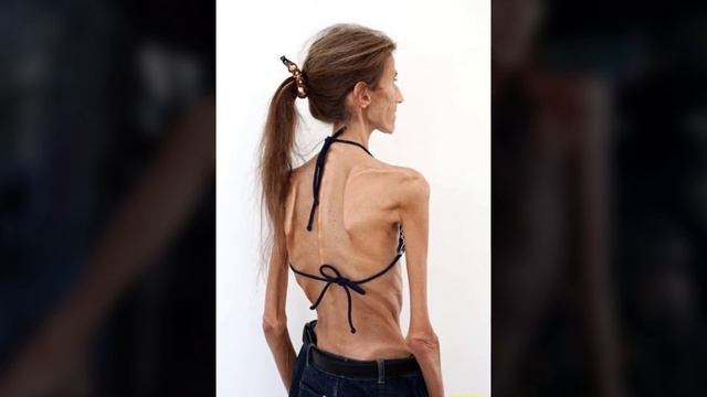 АНОРЕКСИЯ. Страшные фото АНОРЕКСИИ. Самые худые люди мира. ТОП 5 смотреть онлайн