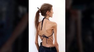 АНОРЕКСИЯ. Страшные фото АНОРЕКСИИ. Самые худые люди мира. ТОП 5