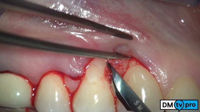 Single gingival recession: treatment with Mucograft matrix смотреть онлайн