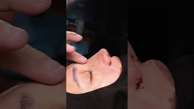Ринопластика - преображение по щелчку! смотреть онлайн