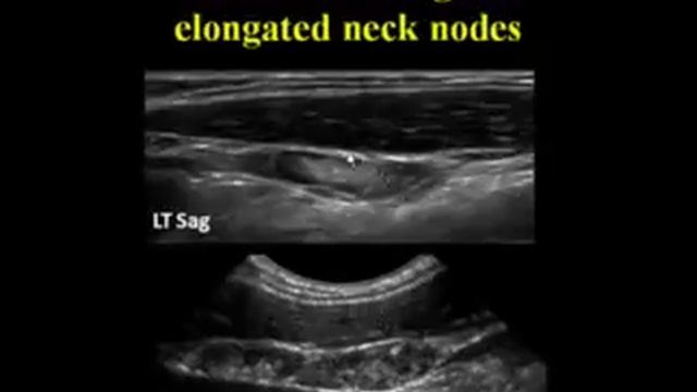 Ultrasound of the Neck There's More to See Than Thyroid Nodules смотреть онлайн