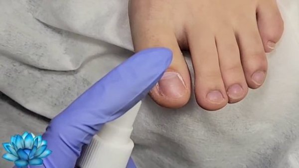 Как вылечить вросший ноготь на пальце ноги.