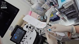 установка спирали Мирена