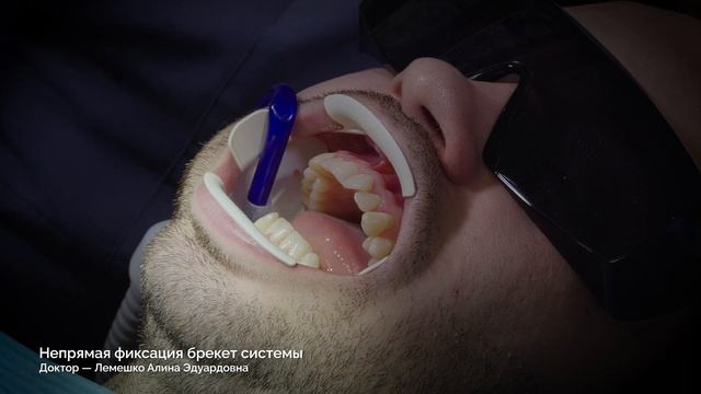 Непрямая фиксация брекет системы смотреть онлайн