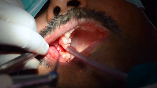 Direct Sinus lift Implant procedure demo with lateral window approach BY DR. PRATIK NARSIKAR смотреть онлайн