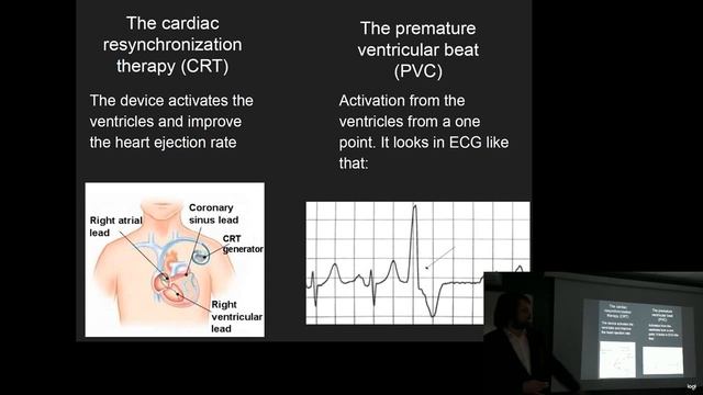 Математическое моделирование в кардиологии. ЧАСТЬ 2 смотреть онлайн