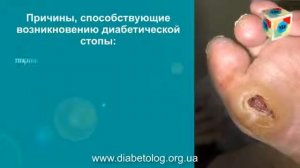 ДИАБЕТИЧЕСКАЯ СТОПА   ПРИЧИНЫ