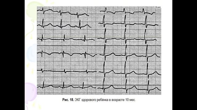 1.04.22 Куприянова АВ Варианты нормальной ЭКГ Детская ЭКГ.mp4