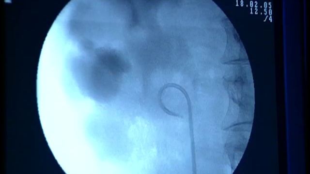Стентирование смотреть онлайн