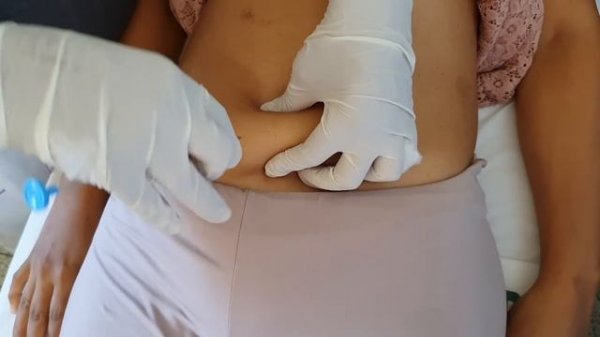 Zoladex pela Enf@ Carine