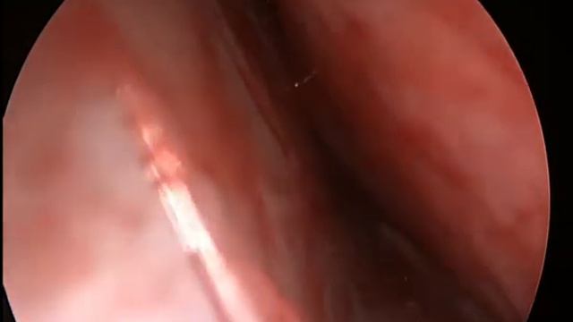 эндоскопическая септопластика(endoskopik Septoplastika)