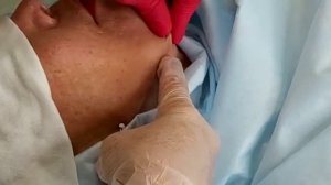 Брыли, лифтинг нижней части лица, мезонити торнадо 90mm.