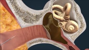 Воспаление среднего уха (Средний отит)