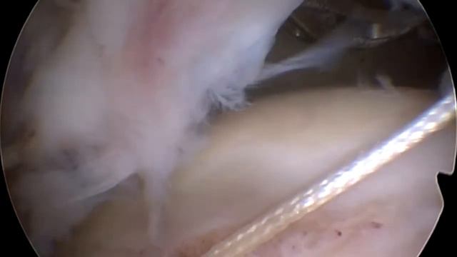 Arthroscopic Double-layer Rotator Cuff Repair - Arthroskopische Rotatorenmanschettenrekonstruktion