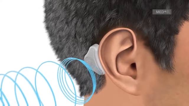 Как работает костная проводимость в аппарате ADHEAR смотреть онлайн
