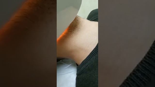 Boyun Lazer Epilasyon смотреть онлайн