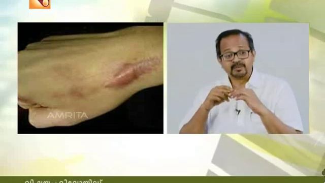 Arogyavaarthakal Amrita TV | Health News : Malayalam | 09 06 17 смотреть онлайн