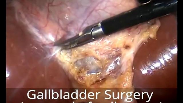 Жёлчный пузырь смотреть онлайн