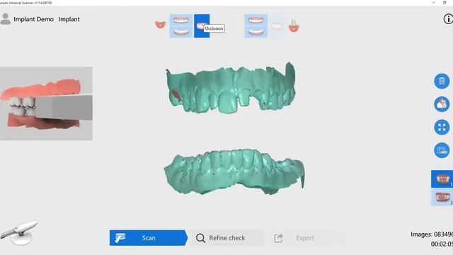 Implant scan workflow смотреть онлайн