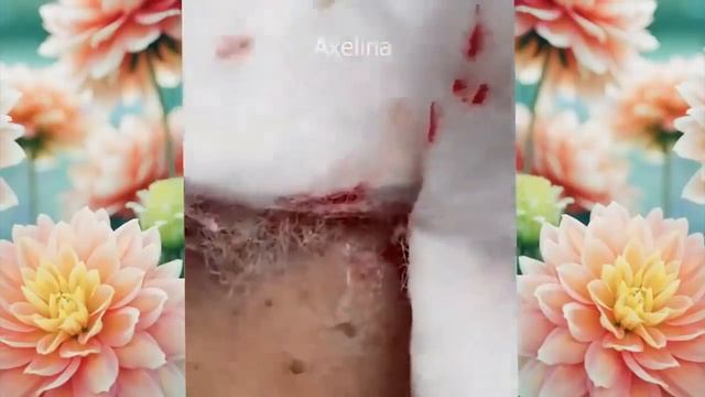 Relax squeezing out blackheads #52 Черные точки смотреть онлайн