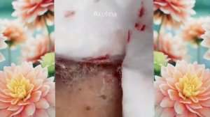 Relax squeezing out blackheads #52 Черные точки