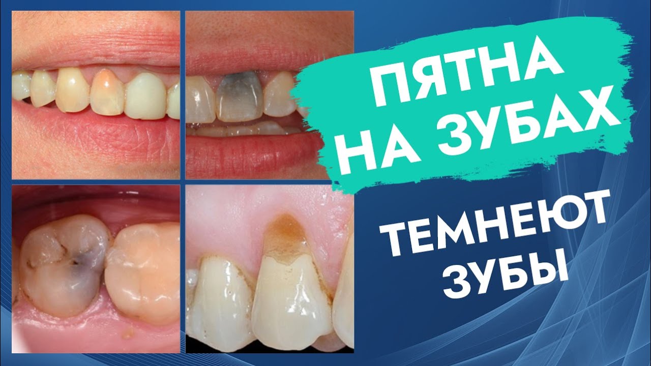Пятна на зубах. Темнеют зубы. смотреть онлайн