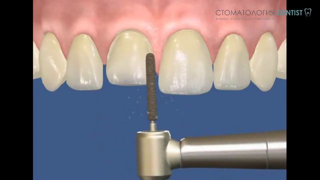 Установка винира на передний верхний зуб. Cтоматология.dentist смотреть онлайн
