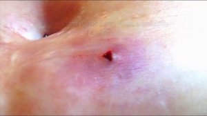 КАК ВЫГЛЯДЯТ УКУСЫ ПИЯВКИ, ПОСТПРИСТАВОЧНАЯ РЕАКЦИЯ ПОСЛЕ УКУСА ПИЯВКИ, СПРЕЙ ПИЯВИТ