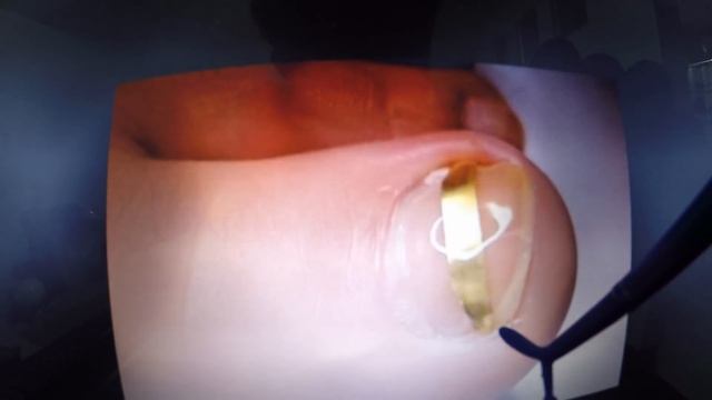 Вросший ноготь на ноге лечение в домашних условиях Ч:2