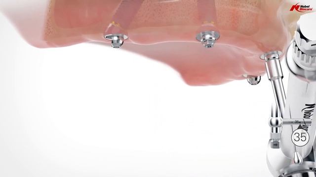 Изготовление зубного протеза на винтовой фиксации. Всё на четырех. смотреть онлайн