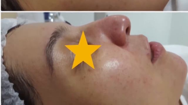 Угри - не повод для комплексов! Лечение и устранение акне и постакне смотреть онлайн