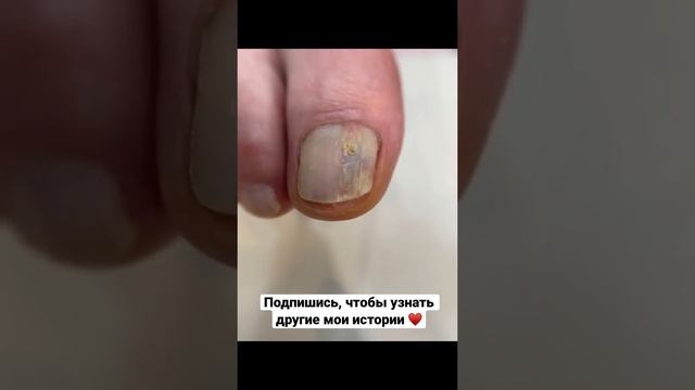 Inst: @podo.blog #подолог #подологспб #podologia #podiatry #педикюр смотреть онлайн