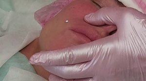 Установка мезонитей - линейные, спираль, при морщинах в области носогубной складки и щек.