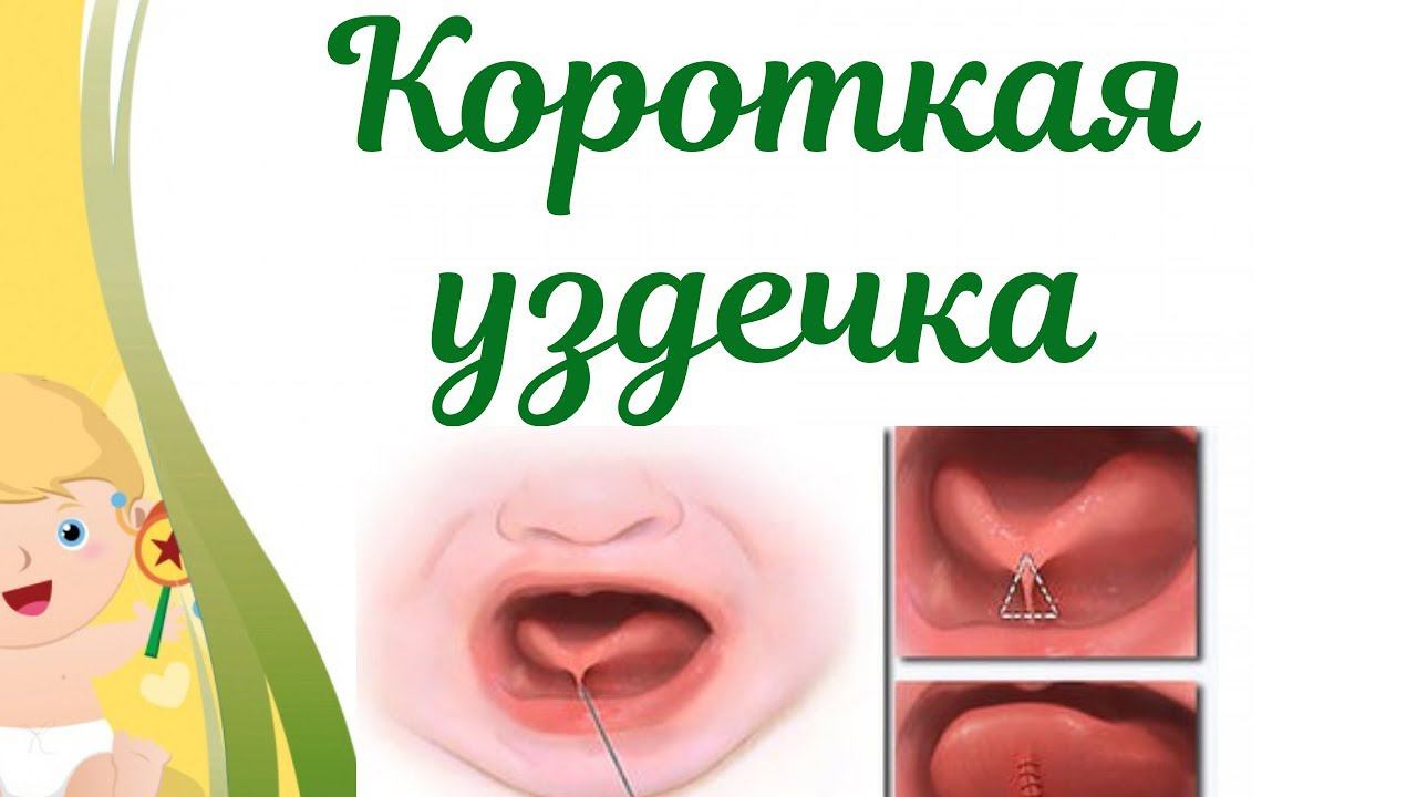 Короткая уздечка под языком у ребенка! Как определить и помочь? смотреть онлайн