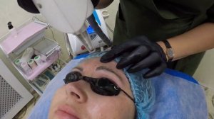 Удаление старого макияжа, «НЕОДИМОВЫЙ ЛАЗЕР»