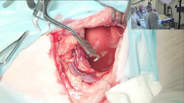 разрыв легких смотреть онлайн