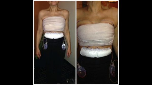 BREAST FAT TRANSFER JOURNAL