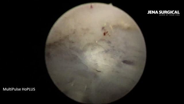 Энуклеация аденомы простаты на гольмиевом лазере MultiPulse HoPLUS (JENA Surgical).Техника EN-Bloc. смотреть онлайн