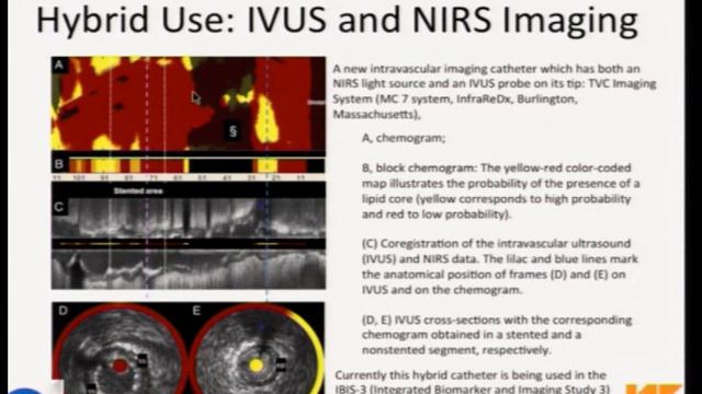 6_8 Dr. Santosh KG Koshy- Current Status of Intravascular imaging at WCCPCI 2014 смотреть онлайн