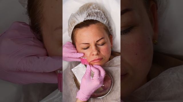 Армирование нижнего века, коррекция носослезной борозды с помощью мезонитей Моно смотреть онлайн