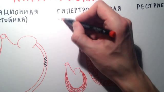 Кардиомиопатии - общая характеристика смотреть онлайн