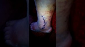 Закрытый перелом лодыжки со смещением моя история 1 часть