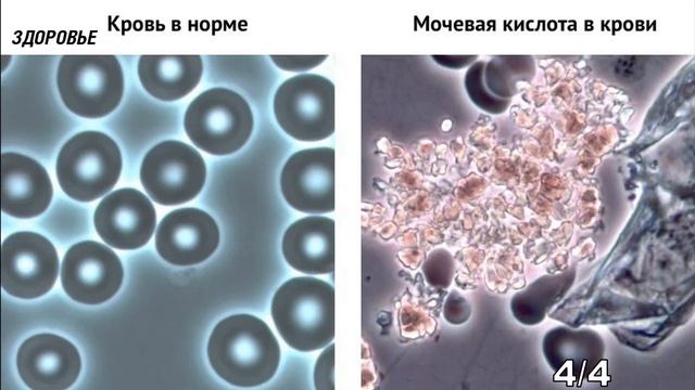 Уровень мочевой кислоты рухнет! Как понизить мочевую кислоту дома смотреть онлайн