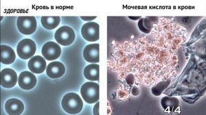 Уровень мочевой кислоты рухнет! Как понизить мочевую кислоту дома