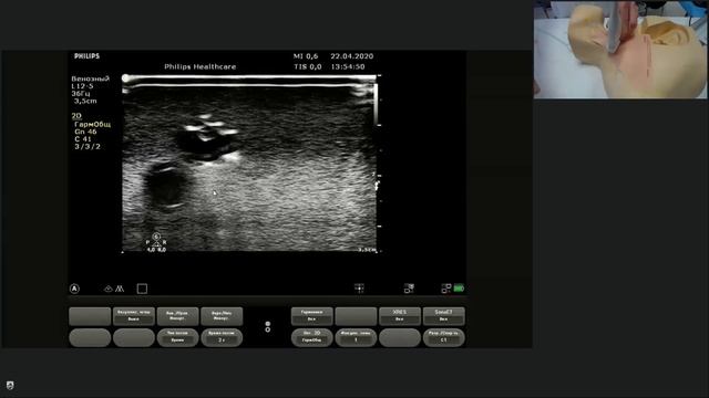 Point-of-Care Ultrasound во время пандемии COVID-19. Ультразвуковая навигация сосудистого доступа смотреть онлайн
