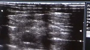 Блокада плечевого сплетения под УЗИ контролем